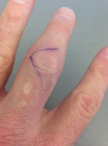 V marks the spot where the surgeon will open up the top of my finger. Notice the scars from flame-driven wart removal as a kid. I guess my left hand is jinxed. 