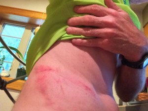 My lower back too a beating from an 8" tree limb. But at least there were no broken bones or ribs. 