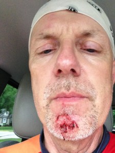 The wound required four stitches. 