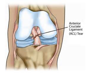 I used a cadaver part for my replacement ACL. I called him Jake. 