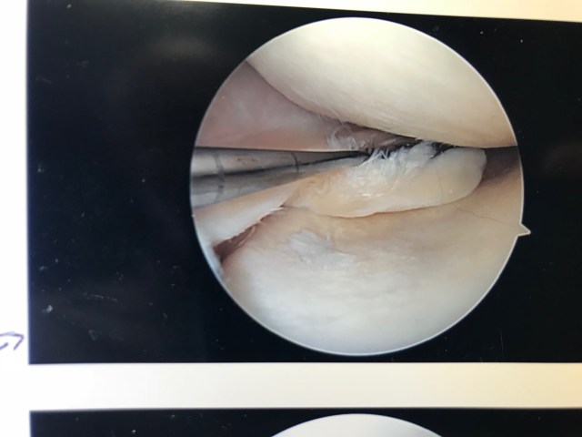 Knee porn excision.jpg